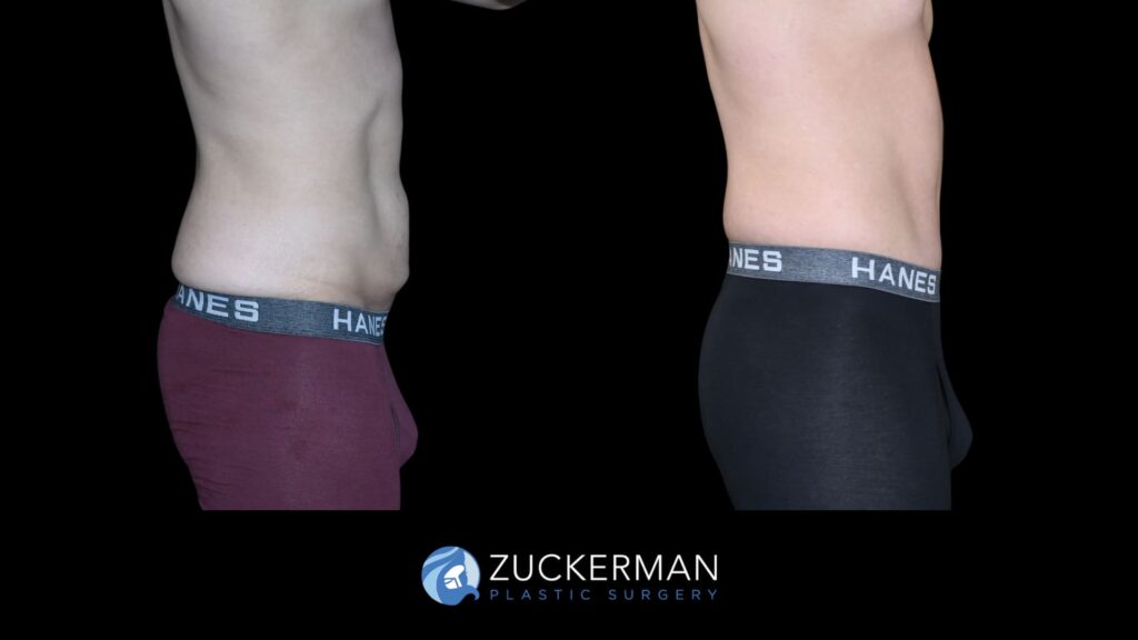 Patient before and after Circumferential Lift | Zuckerman Plastic Surgery