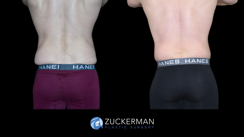 Patient before and after Circumferential Lift | Zuckerman Plastic Surgery