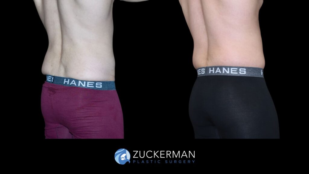 Patient before and after Circumferential Lift | Zuckerman Plastic Surgery