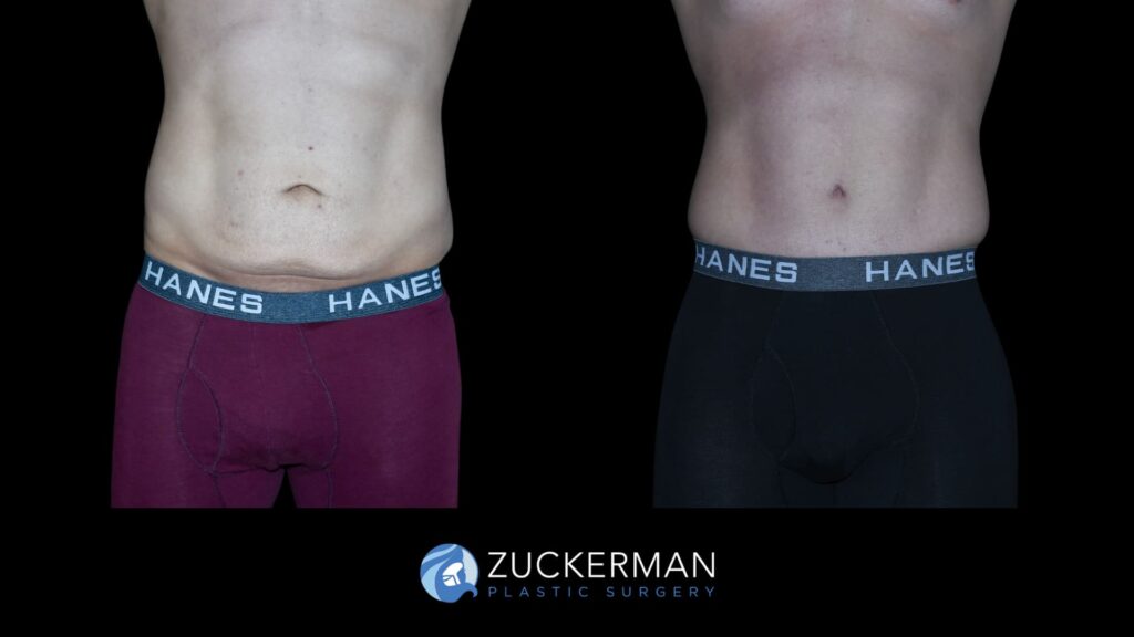 Patient before and after Circumferential Lift | Zuckerman Plastic Surgery