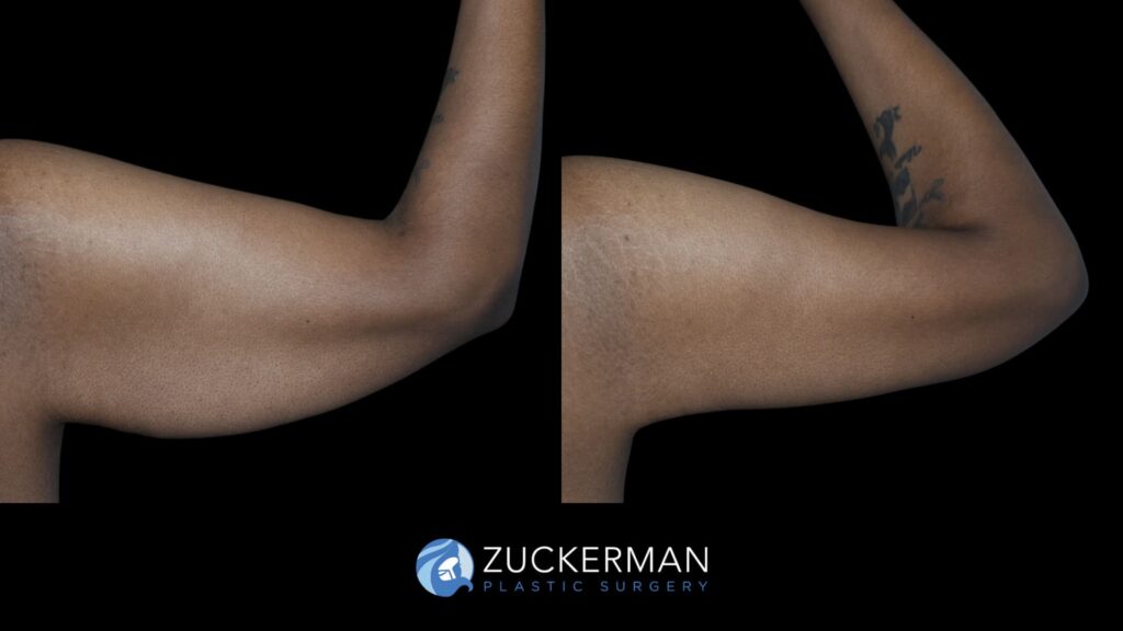 Patient before and after Brachioplasty | Zuckerman Plastic Surgery