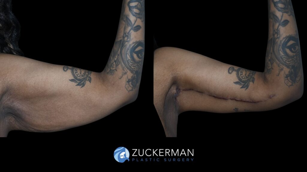 Patient before and after Brachioplasty | Zuckerman Plastic Surgery