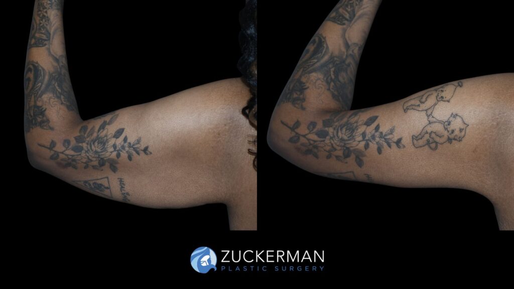 Patient before and after Brachioplasty | Zuckerman Plastic Surgery