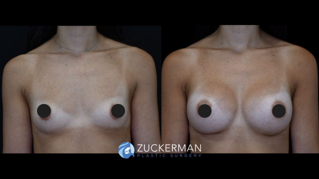 Patient before and after Breast Augmentation | Zuckerman Plastic Surgery