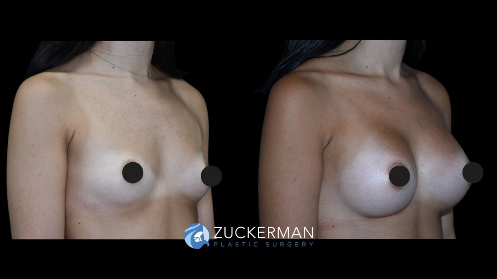 Patient before and after Breast Augmentation | Zuckerman Plastic Surgery