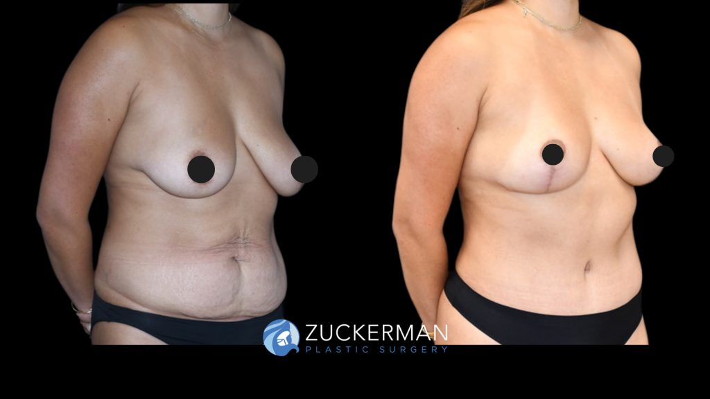 Patient before and after Tummy Tuck & Mastopexy | Zuckerman Plastic Surgery