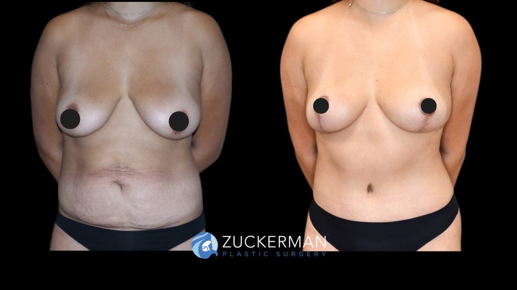 Patient before and after Tummy Tuck & Mastopexy | Zuckerman Plastic Surgery