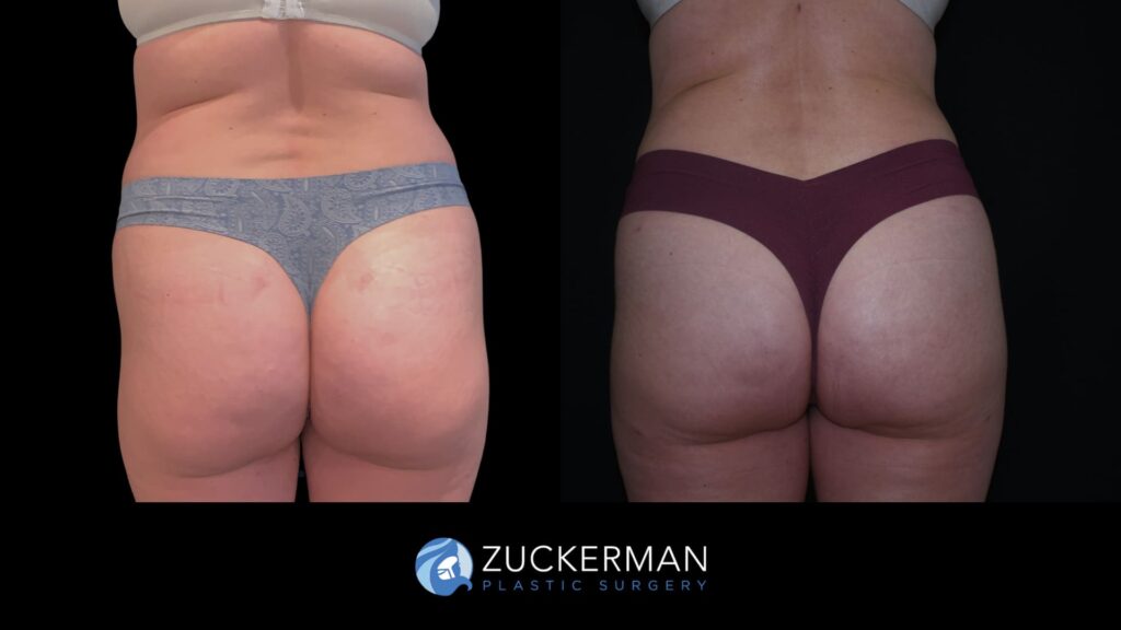 Patient before and after Lipo 360 & Brazilian Butt Lift | Zuckerman Plastic Surgery