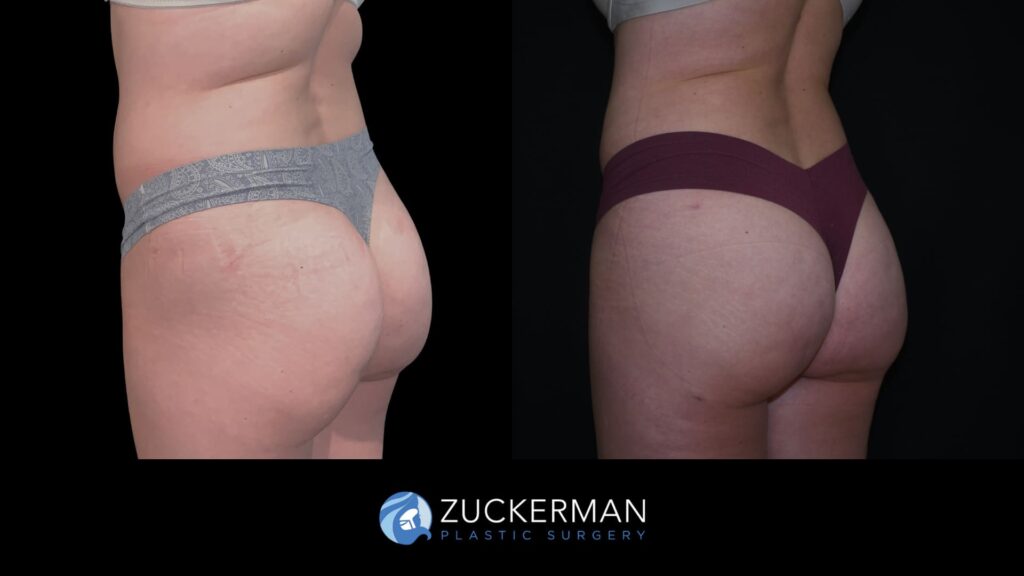 Patient before and after Lipo 360 & Brazilian Butt Lift | Zuckerman Plastic Surgery