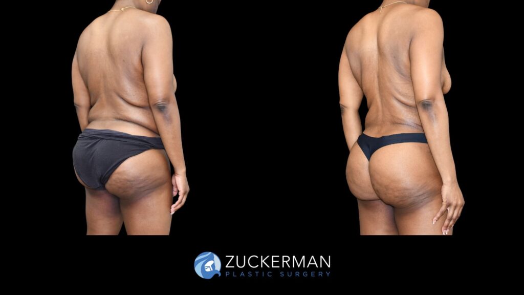 P103 Lipo 360 & Brazilian Butt Lift 1 license confirmed