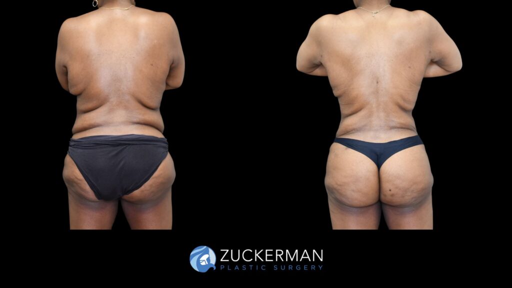 P103 Lipo 360 & Brazilian Butt Lift 2 license confirmed