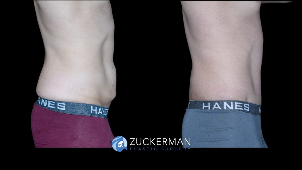 Patient before and after Circumferential Lift | Zuckerman Plastic Surgery