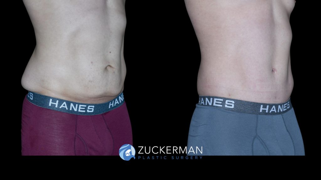 Patient before and after Circumferential Lift | Zuckerman Plastic Surgery