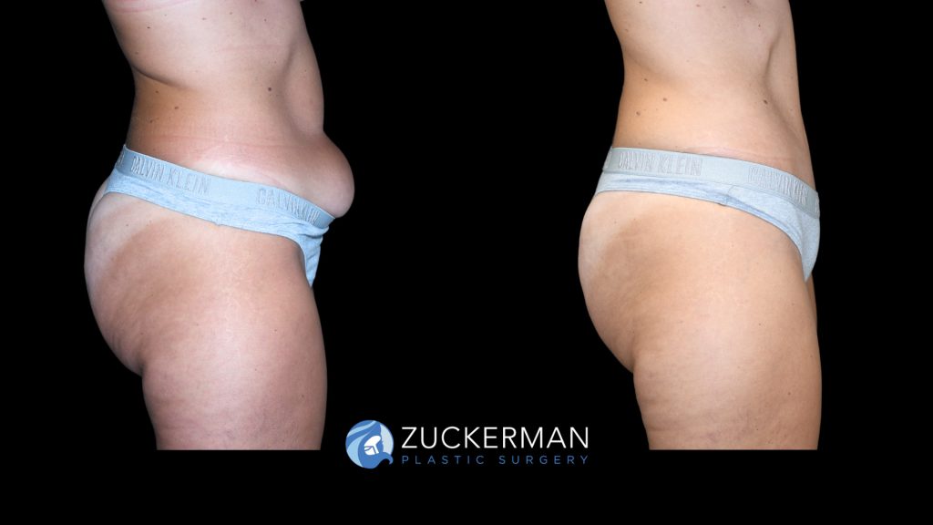 Patient before and after Tummy Tuck | Zuckerman Plastic Surgery