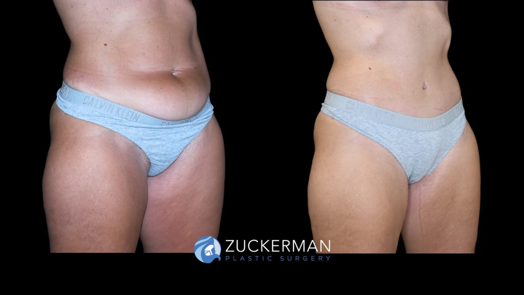 Patient before and after Tummy Tuck | Zuckerman Plastic Surgery