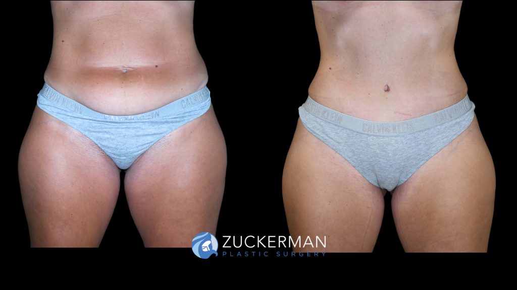 Patient before and after Tummy Tuck | Zuckerman Plastic Surgery