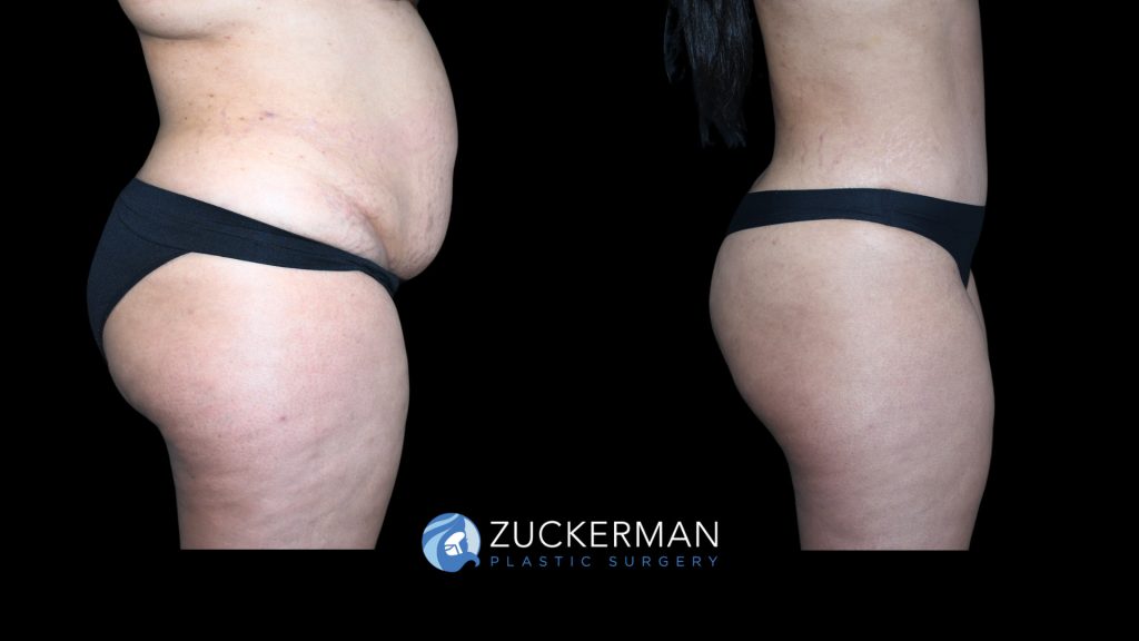 Patient before and after Tummy Tuck | Zuckerman Plastic Surgery