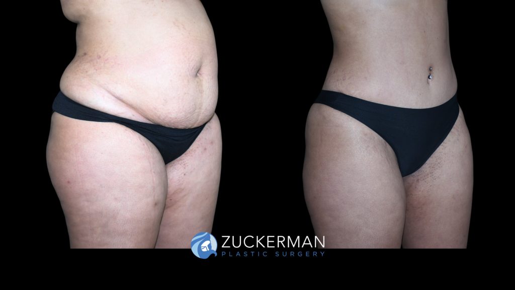 Patient before and after Tummy Tuck | Zuckerman Plastic Surgery