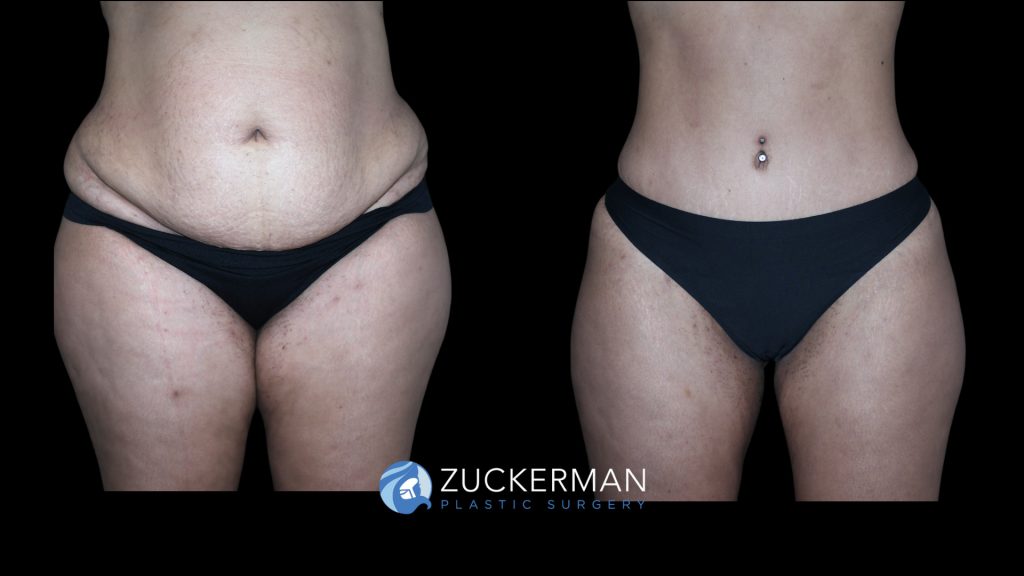 Patient before and after Tummy Tuck | Zuckerman Plastic Surgery