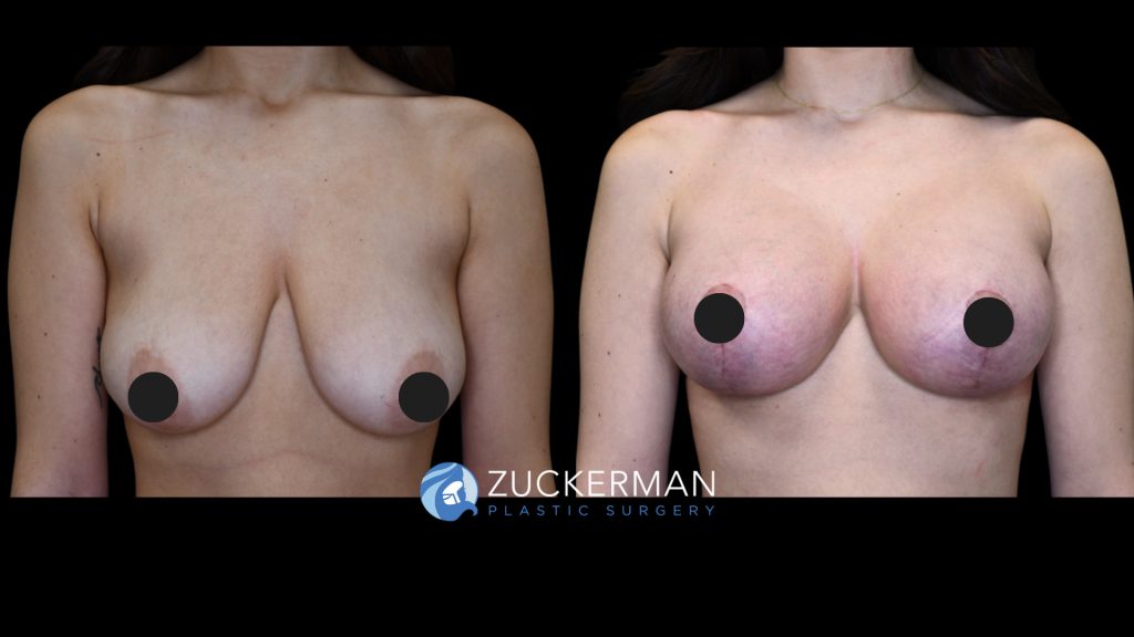 Patent before and after Breast Lift | Zuckerman Plastic Surgery