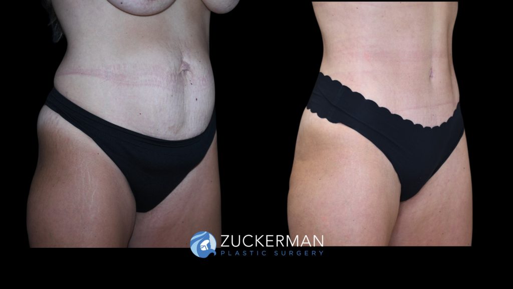 Patient before and after Tummy Tuck | Zuckerman Plastic Surgery