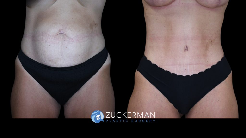 Patient before and after Tummy Tuck | Zuckerman Plastic Surgery