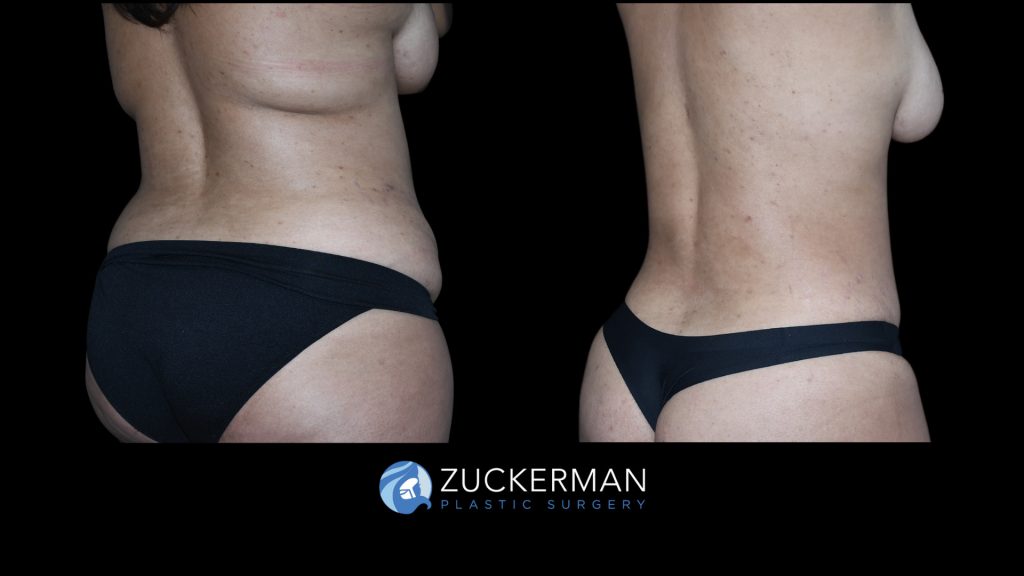 Patient before and after Tummy Tuck | Zuckerman Plastic Surgery