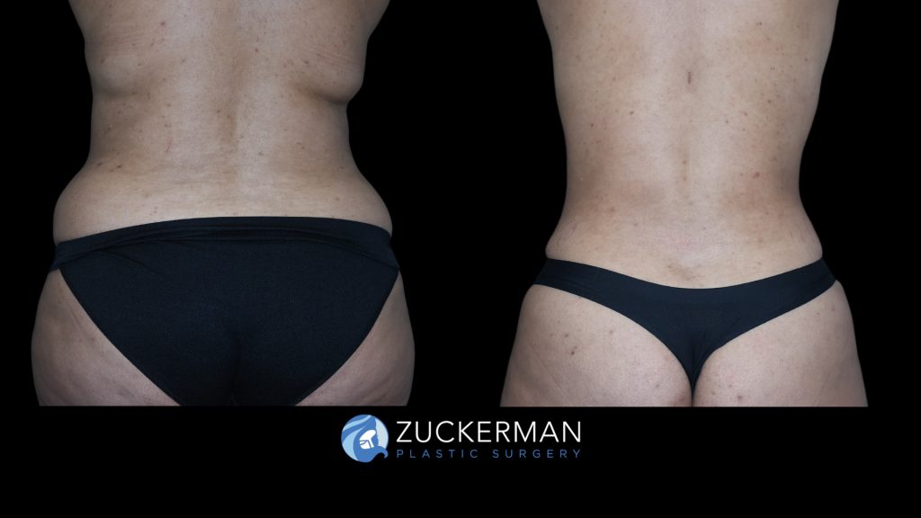 Patient before and after Tummy Tuck | Zuckerman Plastic Surgery