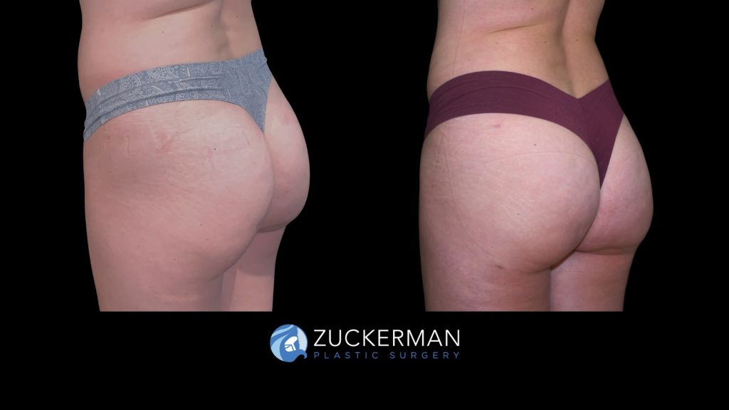 Patient before and after Lipo 360 & Brazilian Butt Lift | Zuckerman Plastic Surgery