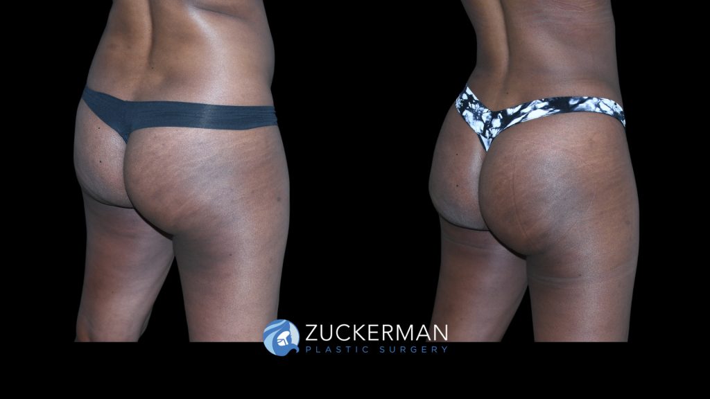 Patient before and after Lipo 360 & Brazilian Butt Lift | Zuckerman Plastic Surgery