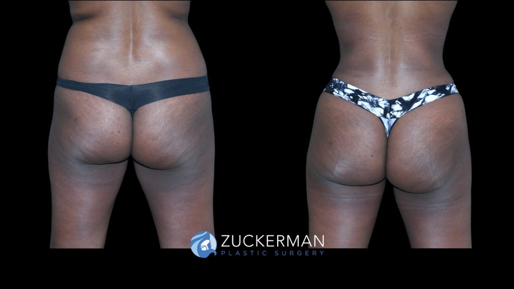 Patient before and after Lipo 360 & Brazilian Butt Lift | Zuckerman Plastic Surgery