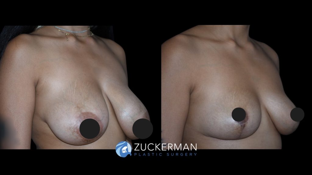 Patient before and after Breast Reduction | Zuckerman Plastic Surgery