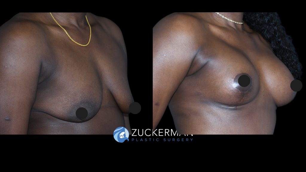 Patent before and after Breast Lift (Mastopexy) | Zuckerman Plastic Surgery