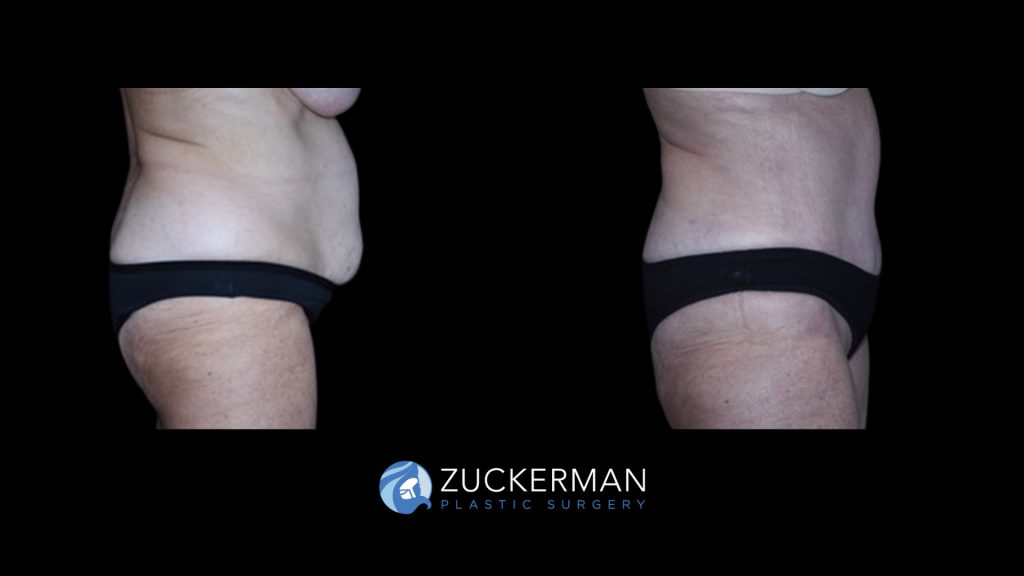 Patient before and after Tummy Tuck | Zuckerman Plastic Surgery