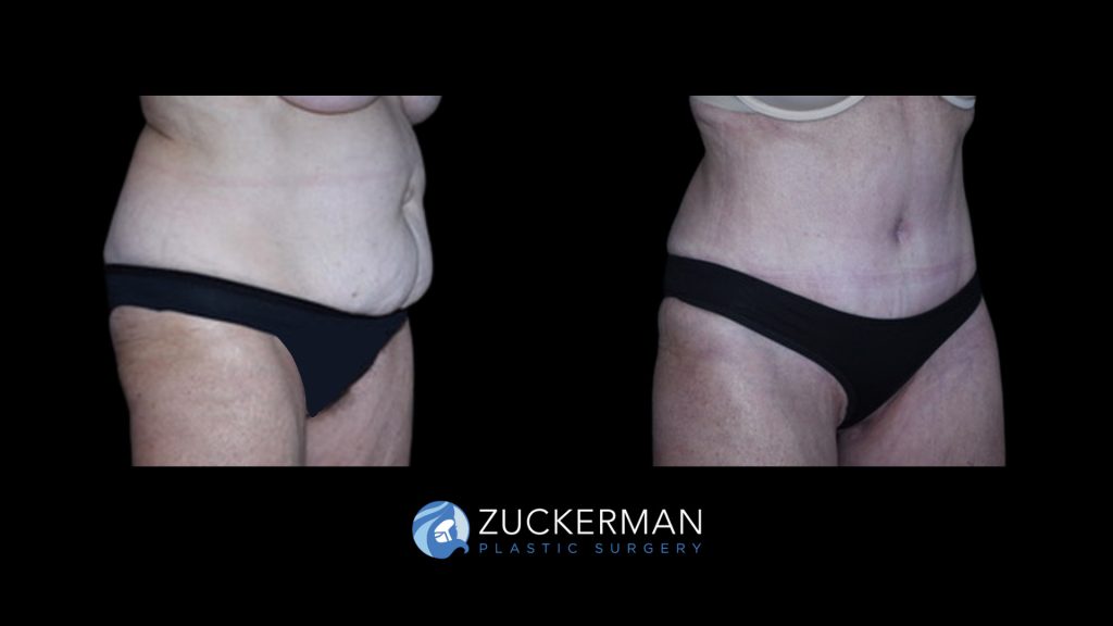 Patient before and after Tummy Tuck | Zuckerman Plastic Surgery