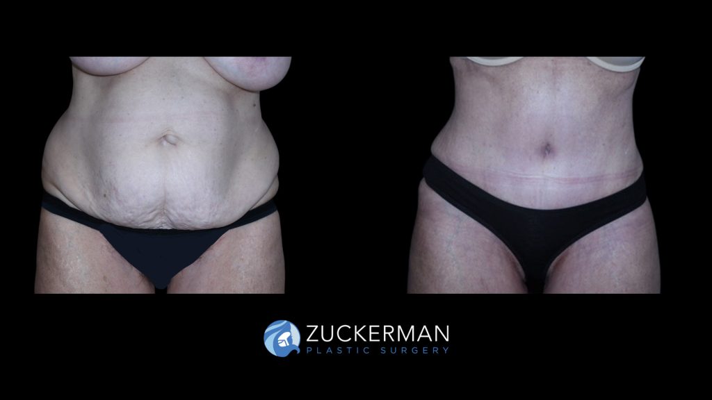 Patient before and after Tummy Tuck | Zuckerman Plastic Surgery