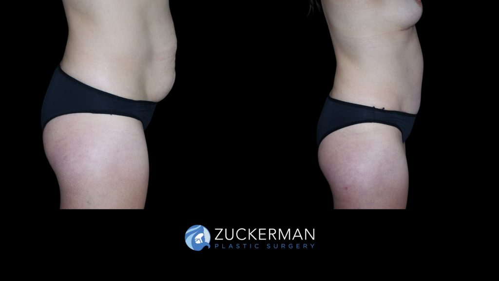 Patient before and after Tummy Tuck | Zuckerman Plastic Surgery