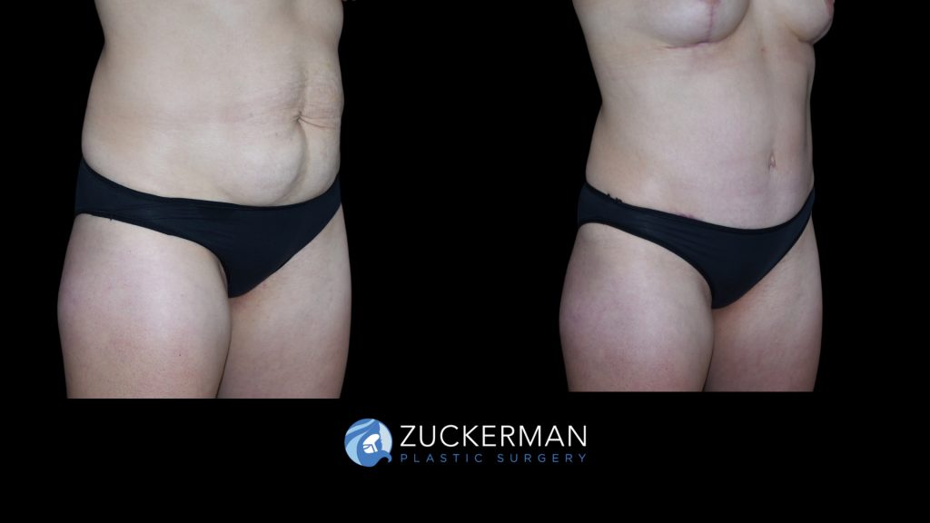 Patient before and after Tummy Tuck | Zuckerman Plastic Surgery