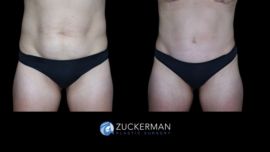 Patient before and after Tummy Tuck | Zuckerman Plastic Surgery