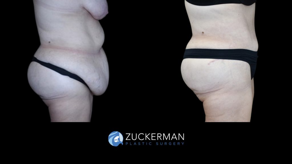 Patient before and after Tummy Tuck | Zuckerman Plastic Surgery