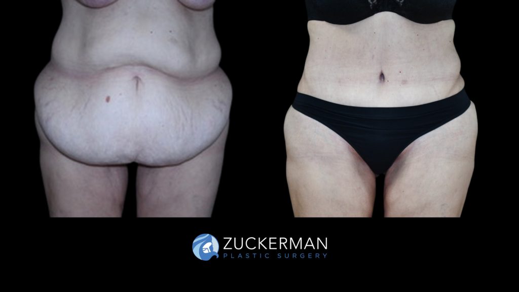 Patient before and after Tummy Tuck | Zuckerman Plastic Surgery