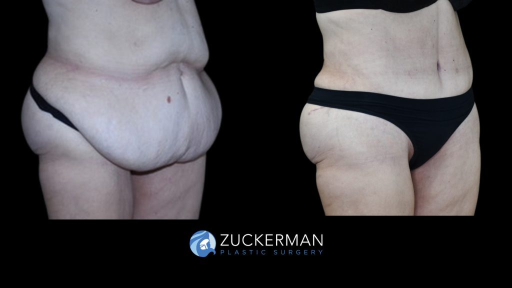 Patient before and after Tummy Tuck | Zuckerman Plastic Surgery