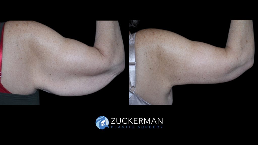 Patient before and after Brachioplasty | Zuckerman Plastic Surgery