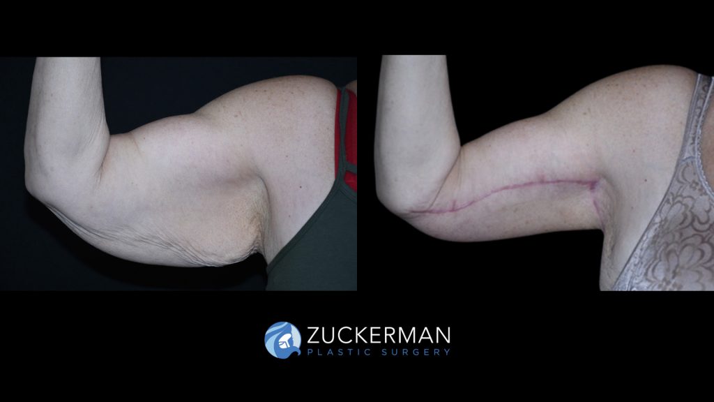 Patient before and after Brachioplasty | Zuckerman Plastic Surgery