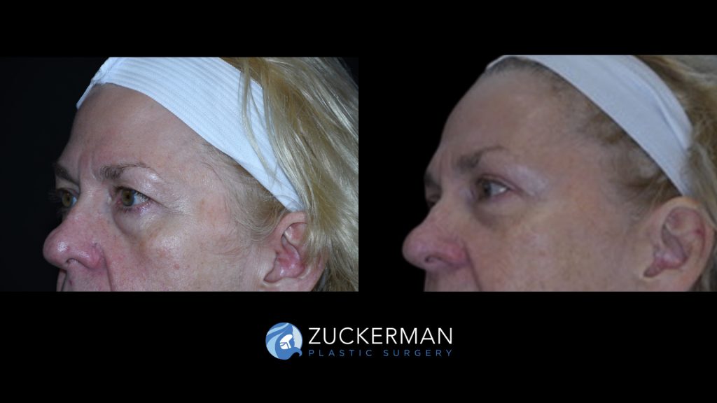 Patient before and after Blepharoplasty | Zuckerman Plastic Surgery