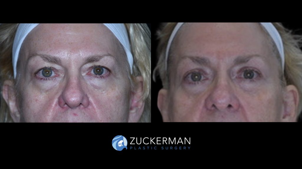 Patient before and after Blepharoplasty | Zuckerman Plastic Surgery