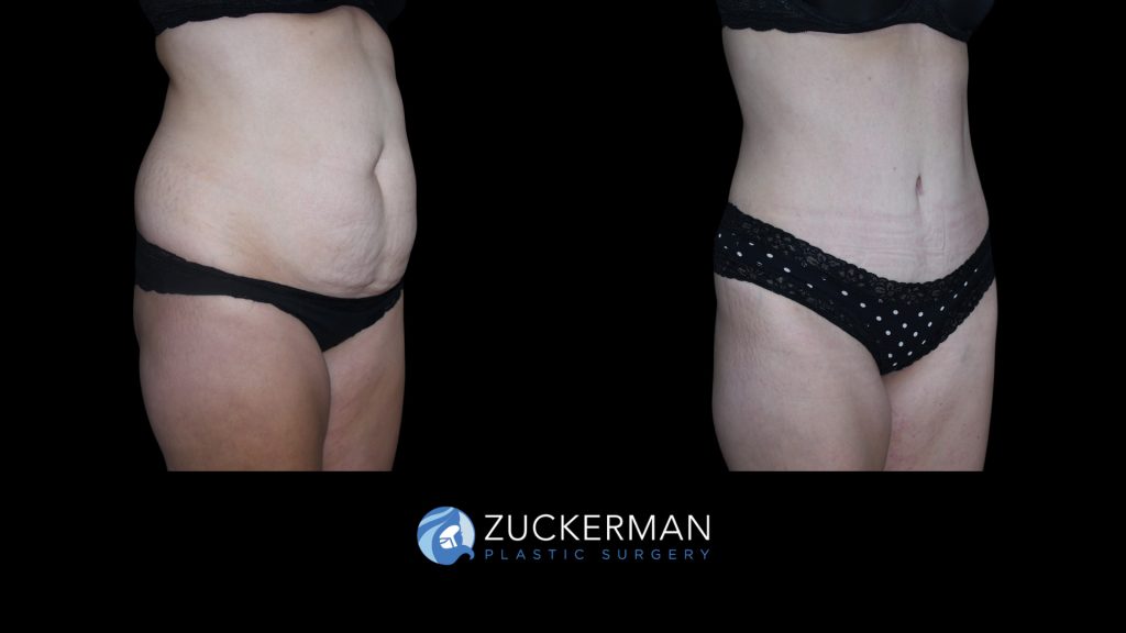 Patient before and after Tummy Tuck | Zuckerman Plastic Surgery