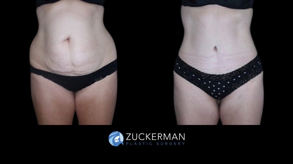 Patient before and after Tummy Tuck | Zuckerman Plastic Surgery