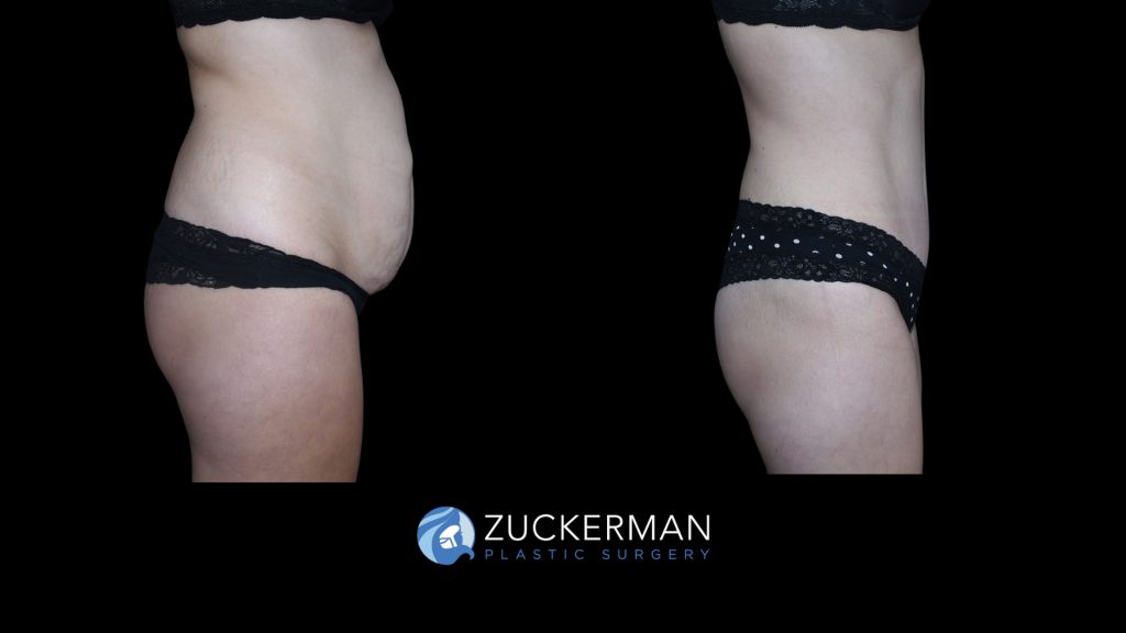 Patient before and after Tummy Tuck | Zuckerman Plastic Surgery