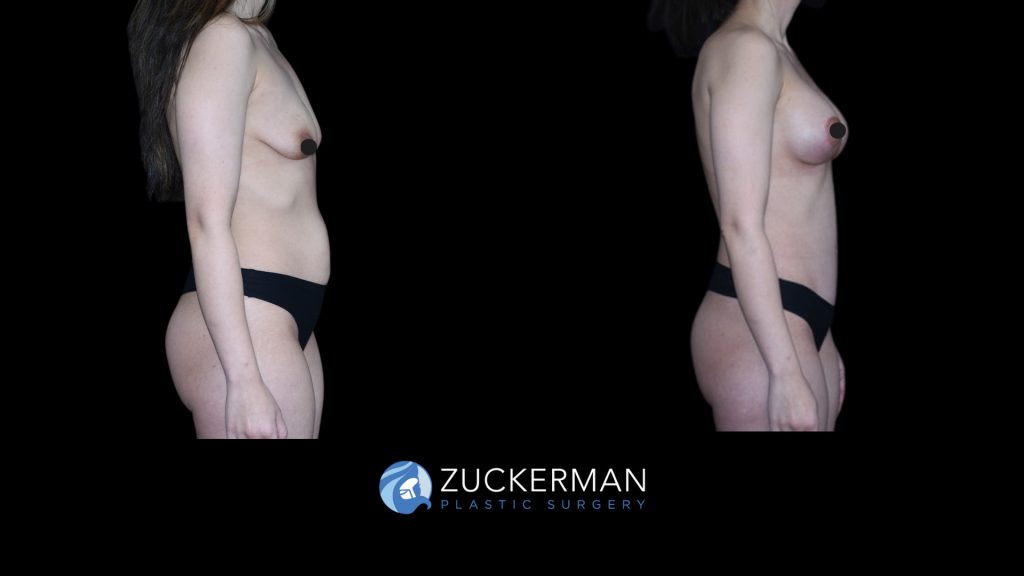 Patient before and after Mommy makeover, Breast Aug & Tummy Tuck | Zuckerman Plastic Surgery